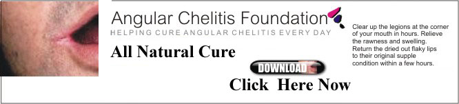 angular cheilitis cure